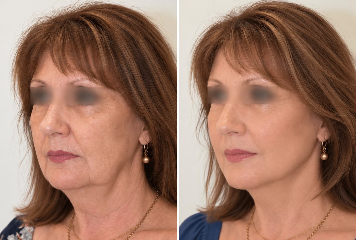 A woman in three-quarter view, eyes obscured, before and twelve weeks after facial fat grafting