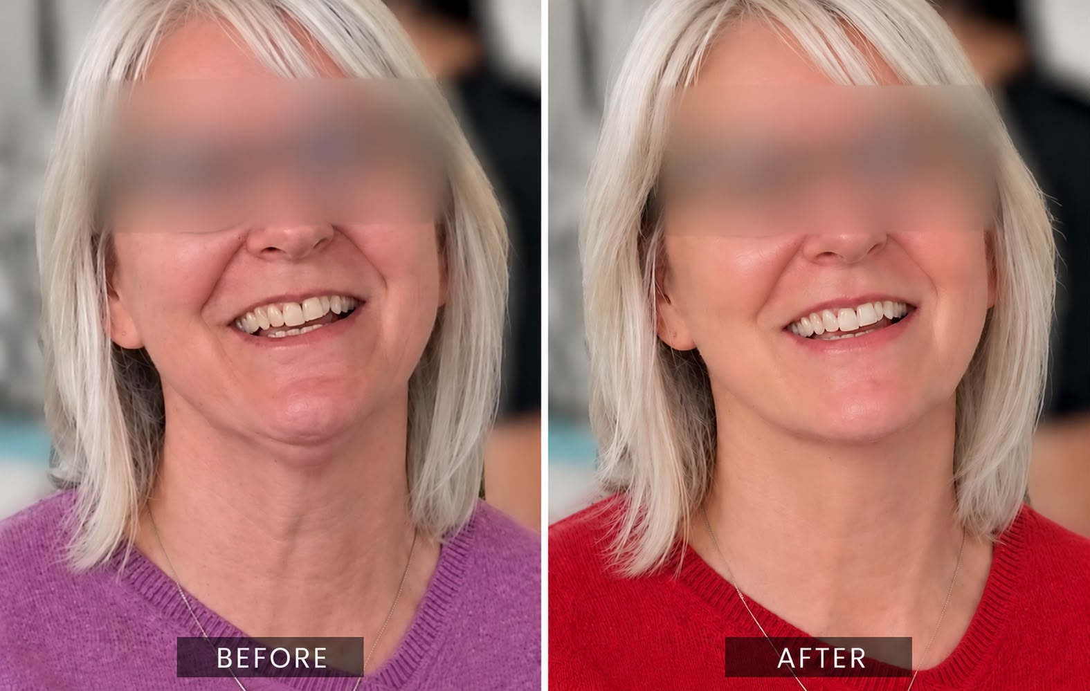A woman smiling, eyes obscured, before and seven weeks after facial fat grafting, showing the lower face, jawline and neck