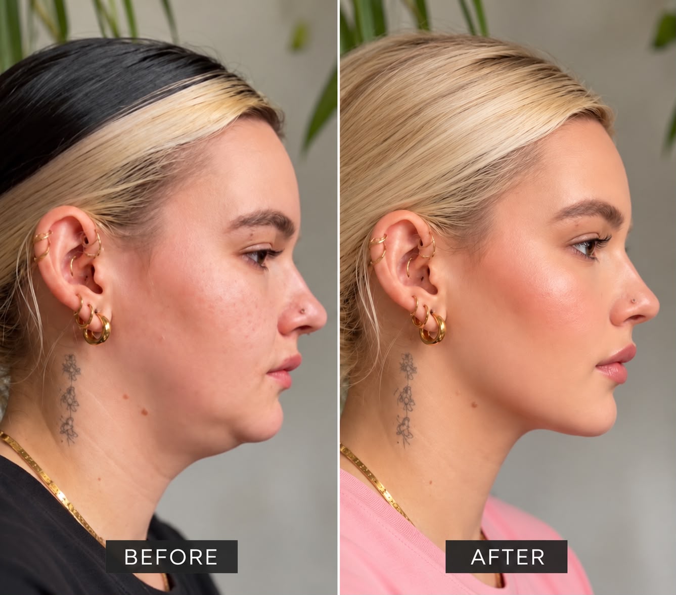 Woman in right profile before and a few days after facial fat grafting by Dr Mario Goisis