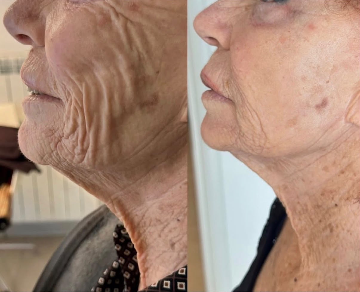 Close-up of an older woman’s lower face and neck in left profile before and after facial fat grafting by Dr Mario Goisis