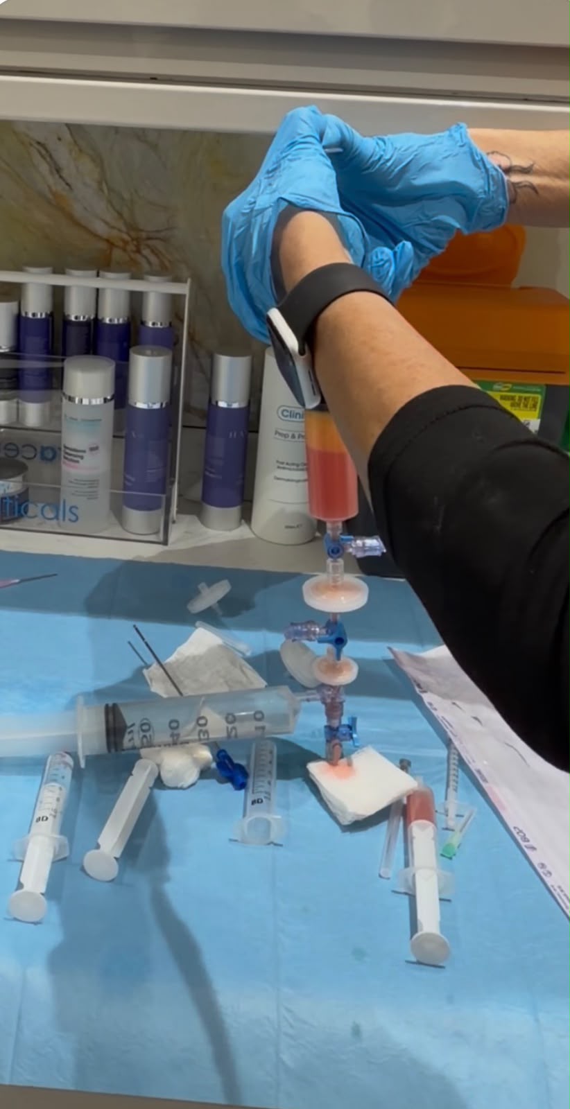 Harvested fat being passed through a series of filters between two syringes